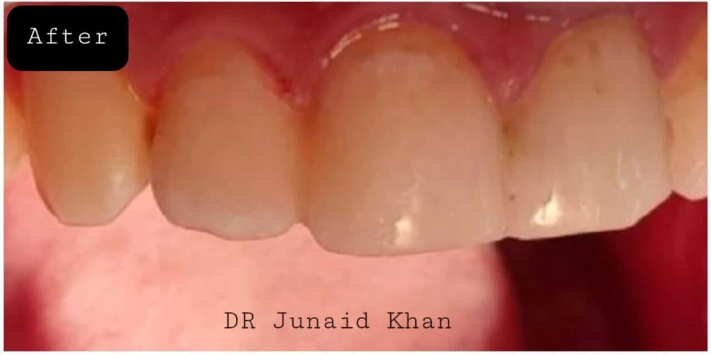teeth whitening before after Peshawar — After treatment