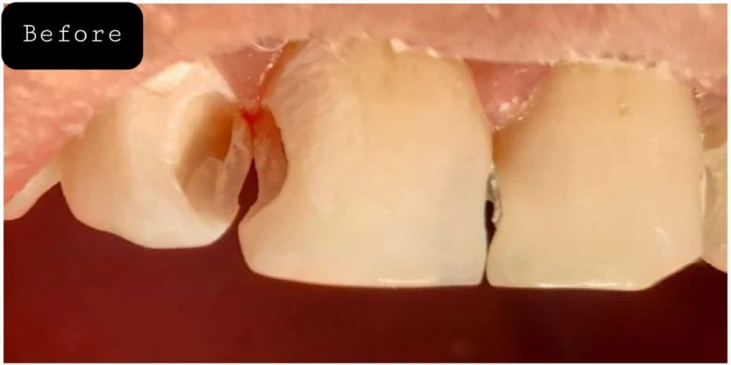 teeth whitening before after Peshawar — Before treatment