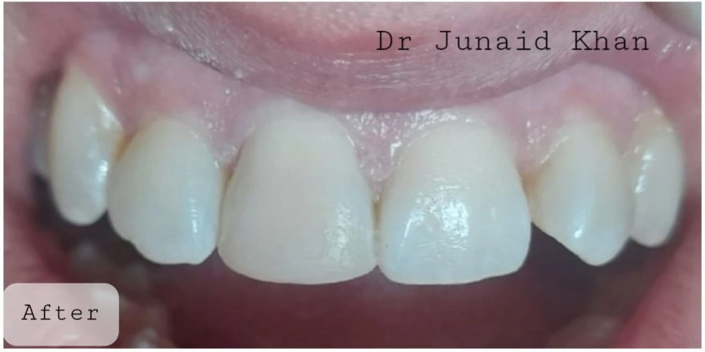 teeth whitening before after Peshawar — After treatment