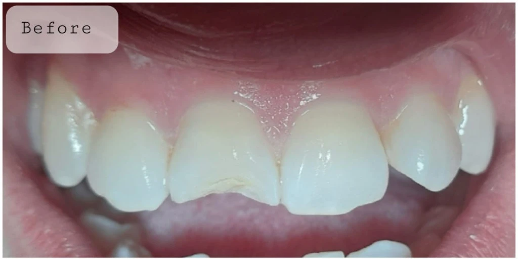 teeth whitening before after Peshawar — Before treatment