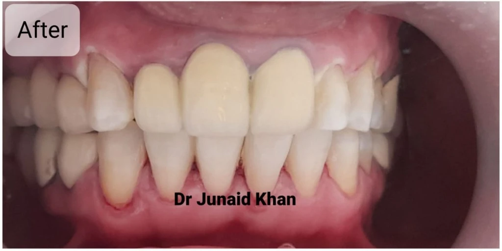 Full Arch Zirconia Crown Smile Makeover — After treatment