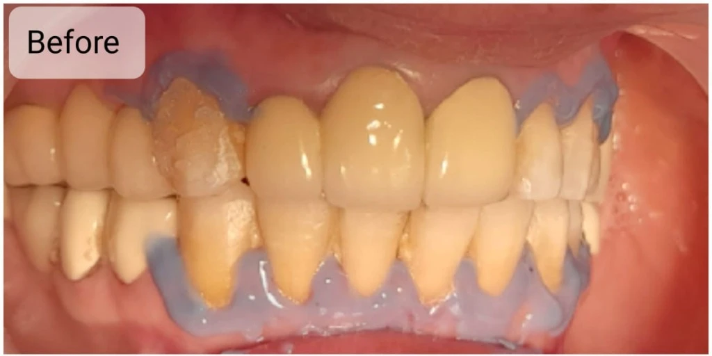 Full Arch Zirconia Crown Smile Makeover — Before treatment