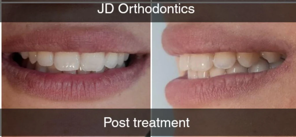 Midline Diastema (Gap) & Overjet Orthodontic Closure — After treatment