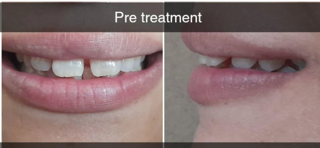 Midline Diastema (Gap) & Overjet Orthodontic Closure — Before treatment