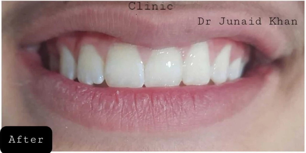 Anterior Crowding & Arch Alignment with Braces — After treatment