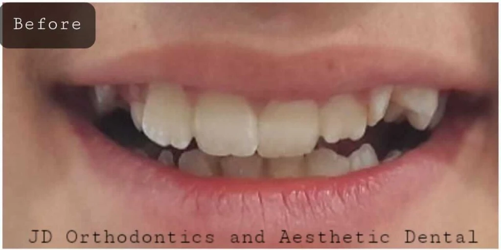 Anterior Crowding & Arch Alignment with Braces — Before treatment